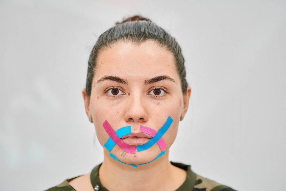 тейпирование носогубных складок